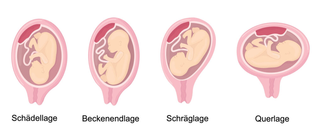 die verschiedenen kindslagen - Kindslage: So liegt dein Baby im Bauch