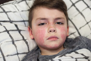 Scharlach-Symptome bei Kindern: typischer Hautausschlag im Gesicht