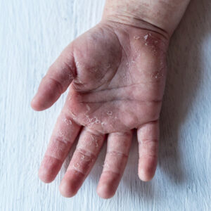 Haut schält sich an der Hand