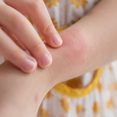 Krätze bei Kindern Arm - Krätze bei Kindern: Wenn die Milben in der Nacht zuschlagen