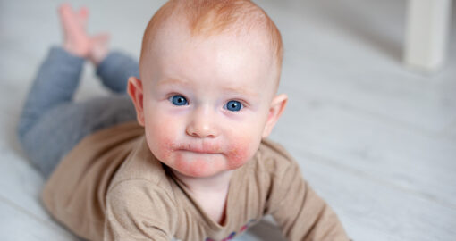 Baby mit Allergie - Ekzem im Gesicht