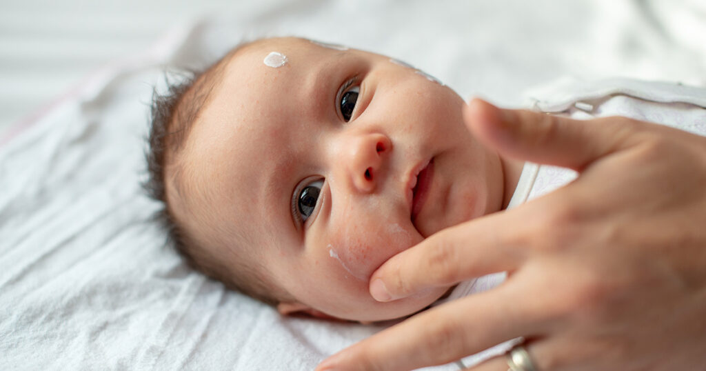 milchschorf behandlung - Milchschorf beim Baby erkennen, behandeln & entfernen