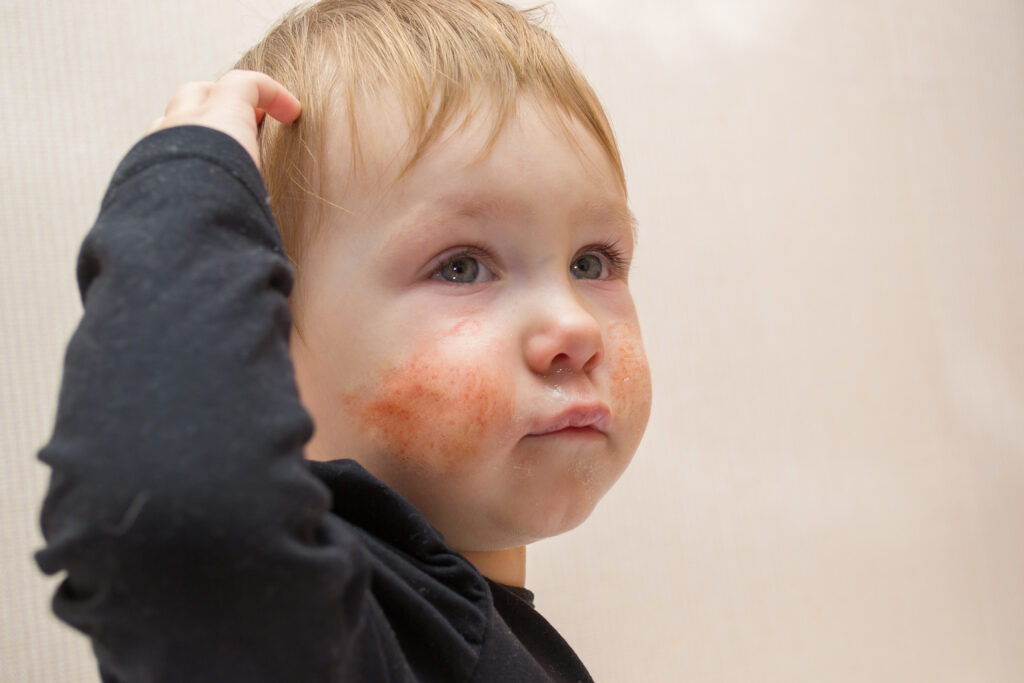 Kleinkind mit Milchschorf im Gesicht