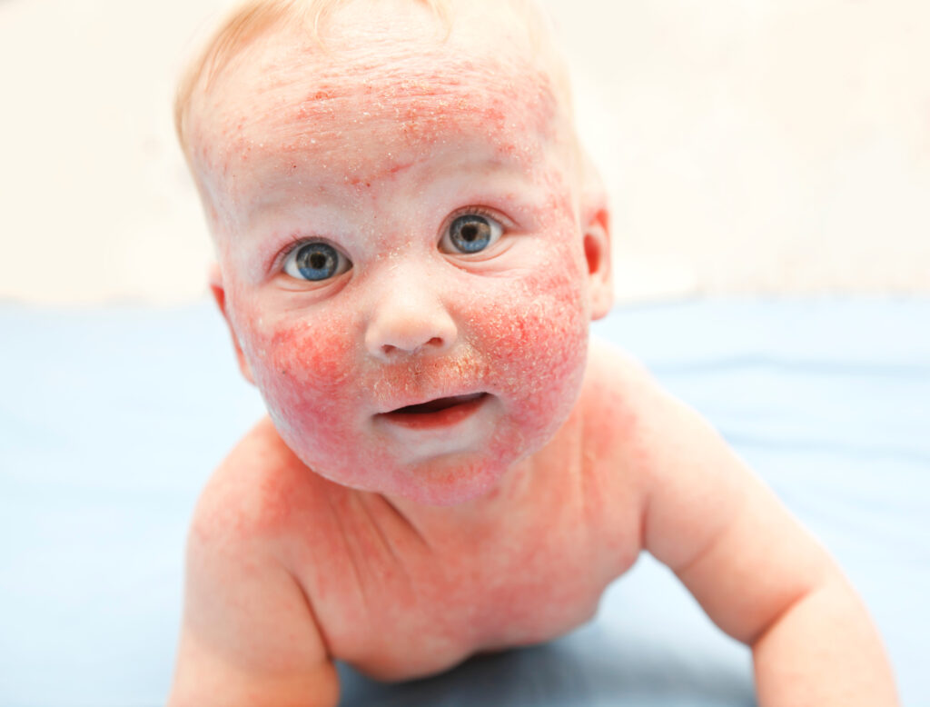 Baby mit Milchschorf im Gesicht und am Körper