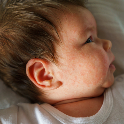 Neurodermitis Baby - Neurodermitis bei Kindern: Was Eltern tun können