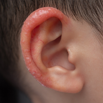 Neurodermitis Ohr - Neurodermitis bei Kindern: Was Eltern tun können