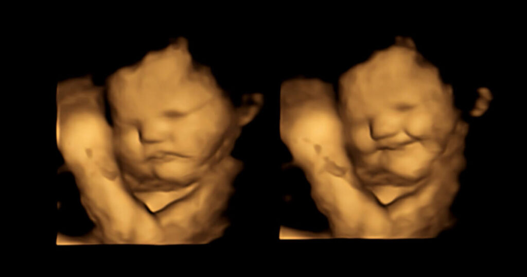 4D Ultraschall lachendes Baby (Fetal and Neonatal Research Lab, Durham University)