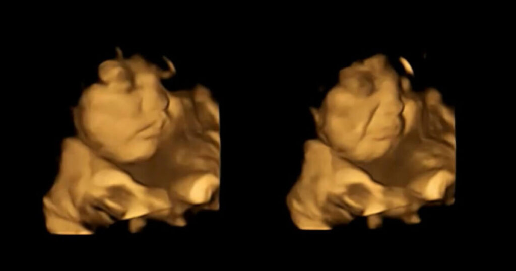 4D Ultraschall weinendes Baby (Fetal and Neonatal Research Lab, Durham University)