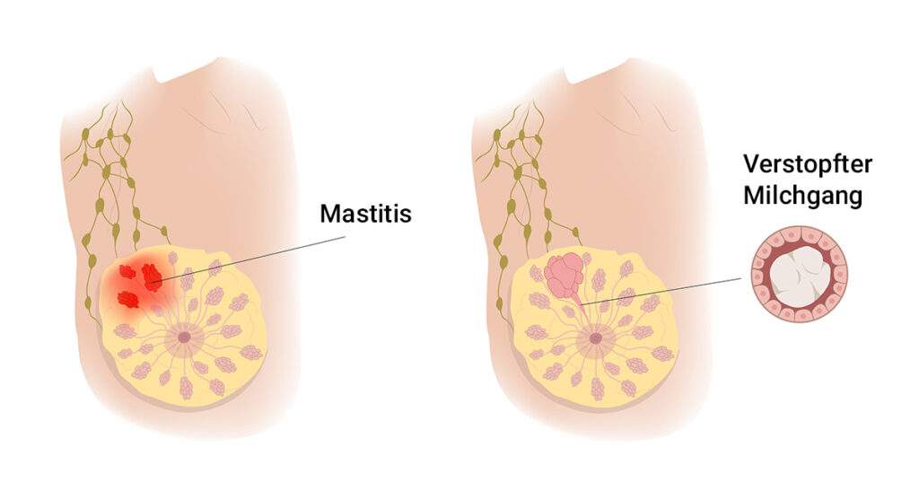 mastitis vs milchstau - Brustentzündung beim Stillen (Mastitis): Symptome, Ursache und Behandlung