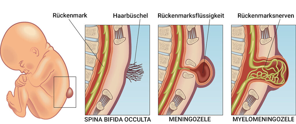spina bifida typen 1 - Offener Rücken beim Baby: Folsäure beugt vor!
