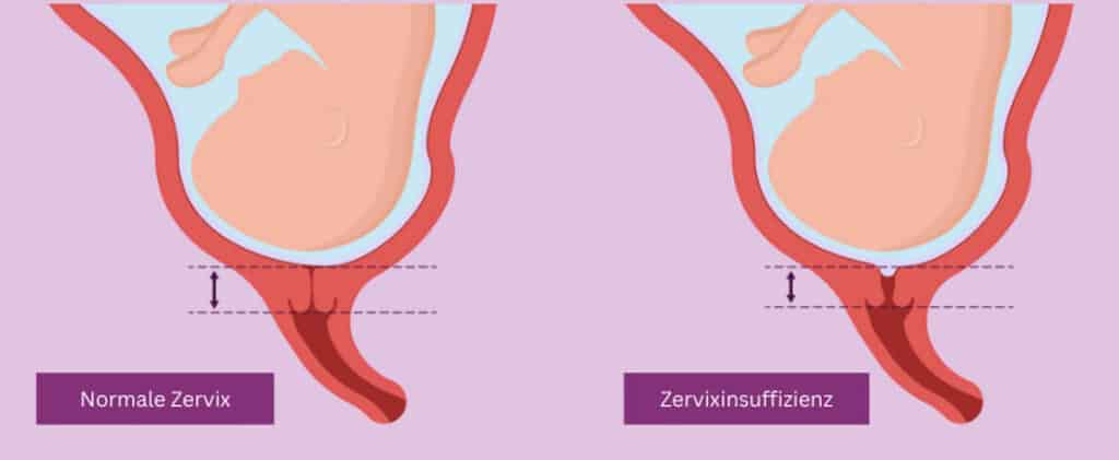 Verkürzte Zervix bei Zervixinsuffizienz