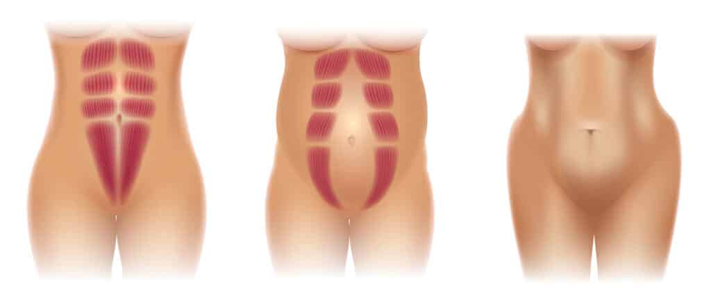 Die geraden Bauchmuskeln vo - Rektusdiastase in und nach der Schwangerschaft: Symptome, Ursache & Behandlung