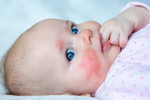 Allergien beim Baby und Stillen
