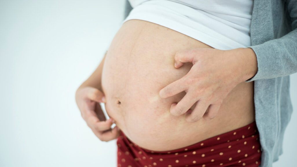 Juckreiz in der Schwangerschaft: Was steckt dahinter?