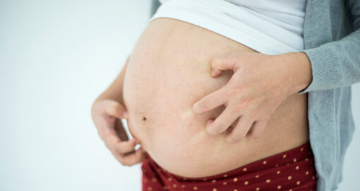 Juckreiz in der Schwangerschaft ist unangenehm, aber ist er schlimm?