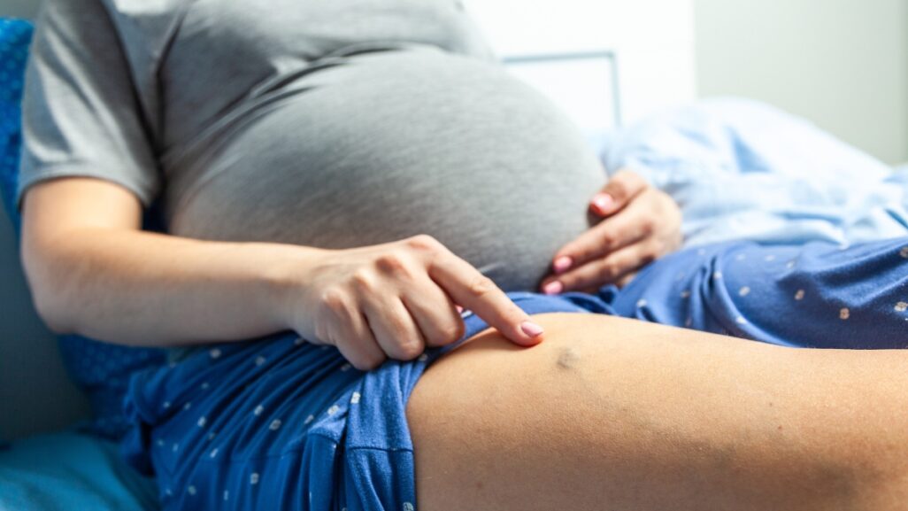 Krampfadern in der Schwangerschaft