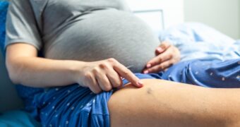 Krampfadern in der Schwangerschaft